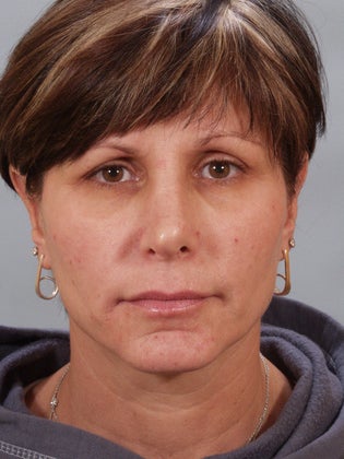 Revision Rhinoplasty before 876688