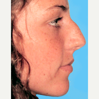 Rhinoplasty before 3814217