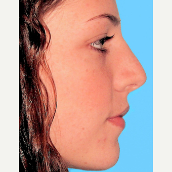 Rhinoplasty after 3814217