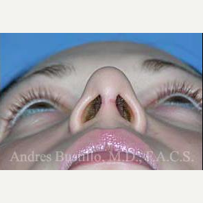 28 year old woman treated with Rhinoplasty after 3460991