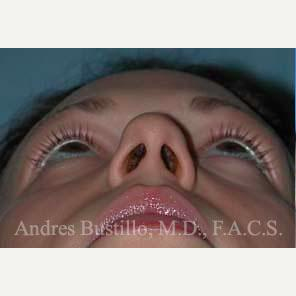 28 year old woman treated with Rhinoplasty before 3460991