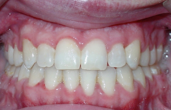 Severe Underbite Treated with Braces and Orthognathic Surgery 1932379