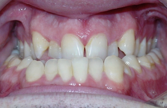 Severe Underbite Treated with Braces and Orthognathic Surgery 1932379
