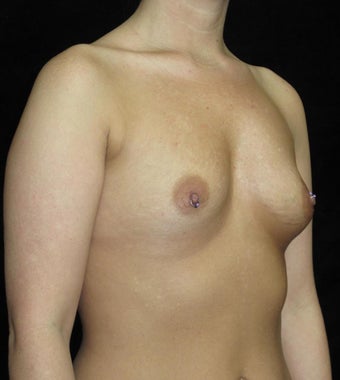 30 year old woman treated with Breast Augmentation 3802772
