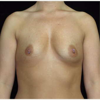 30 year old woman treated with Breast Augmentation before 3802772