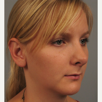 18-24 year old woman treated with Chin Surgery and Rhinoplasty after 3344187