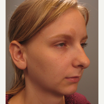 18-24 year old woman treated with Chin Surgery and Rhinoplasty before 3344187