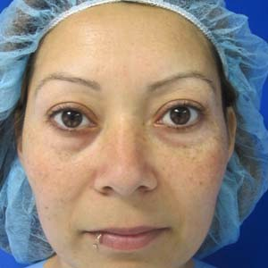 Eyelid Surgery before 3164340