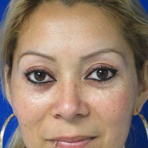 Eyelid Surgery after 3164340