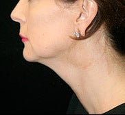 Neck Lift with Lower Face Lift before 1258901