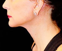Neck Lift with Lower Face Lift after 1258901