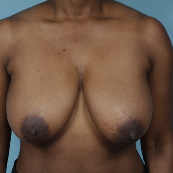 45-54 year old woman treated with Breast Reduction before 3730040