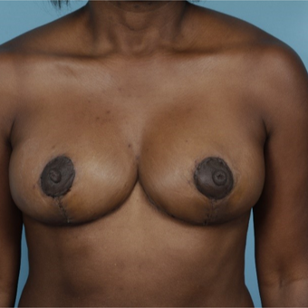 45-54 year old woman treated with Breast Reduction after 3730040