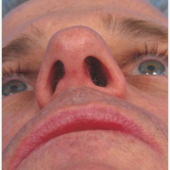 35-44 year old man treated with Septoplasty after 1877582