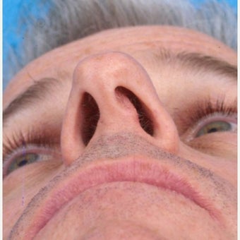 35-44 year old man treated with Septoplasty before 1877582