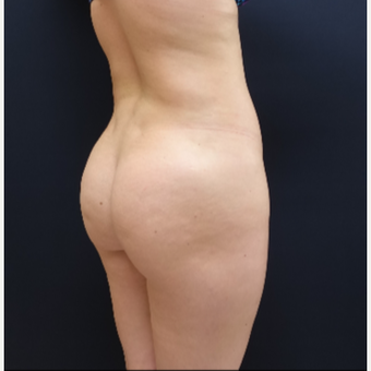 25-34 year old woman treated with Butt Lift using 712cc Round Silicone Implants before 3259569