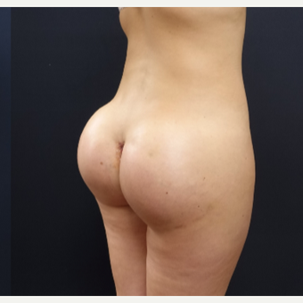 25-34 year old woman treated with Butt Lift using 712cc Round Silicone Implants after 3259569