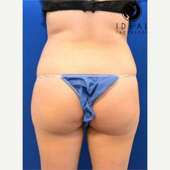 Liposuction with Fat Transfer before 3260012