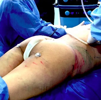 35-44 year old woman treated with Vaser Liposuction before 1943527