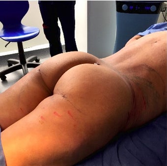 35-44 year old woman treated with Vaser Liposuction after 1943527