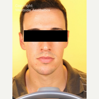 Non Surgical Chin Enhancement on Young Man after 2955310