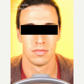 Non Surgical Chin Enhancement on Young Man before 2955310