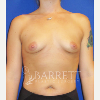 35-44 year old woman treated with Breast Augmentation before 3611961
