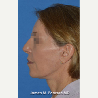 55-64 year old woman treated with Facelift after 3814875
