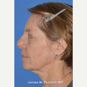 55-64 year old woman treated with Facelift before 3814875