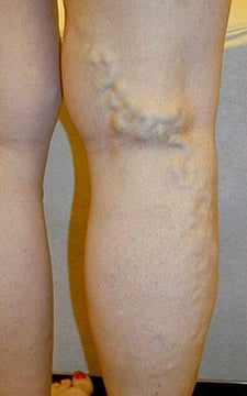 Varicose Vein Treatment Photographs before 914973