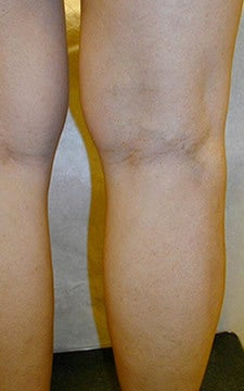 Varicose Vein Treatment Photographs after 914973