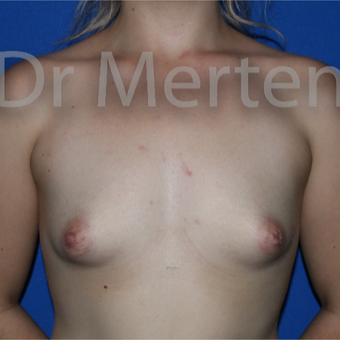25-34 year old woman treated with Breast Lift with Implants before 3591742