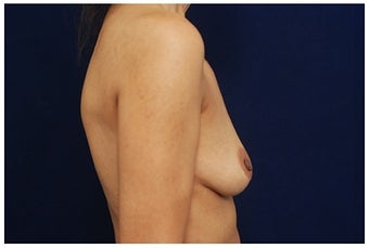 Breast Augmentation before 1335377
