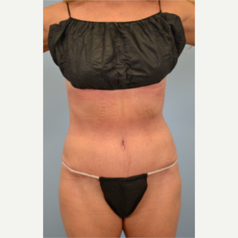 52 year old woman treated with Tummy Tuck after 3432214