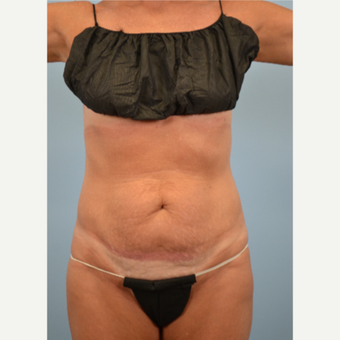 52 year old woman treated with Tummy Tuck before 3432214