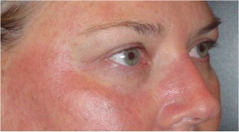 Restylane before 686390