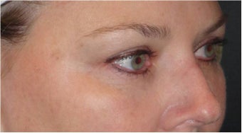 Restylane after 686390