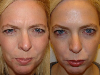 Female treated for glabella and wrinkles on forehead before 971185