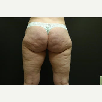 45-54 year old woman treated with Butt Lift before 2081168