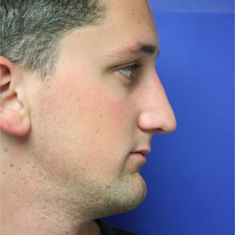 18-24 year old man treated with Rhinoplasty after 3400544