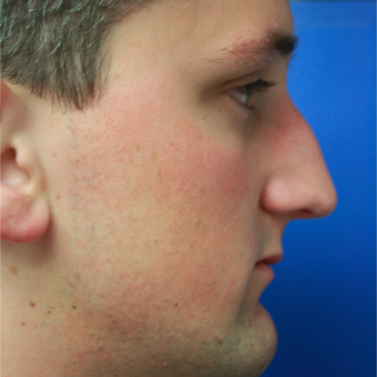 18-24 year old man treated with Rhinoplasty before 3400544