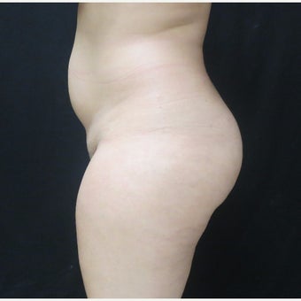 18-24 year old woman treated with Brazilian Butt Lift, 1000cc per side before 2043157