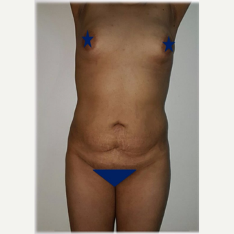 25-34 year old woman treated with Tummy Tuck before 3176246