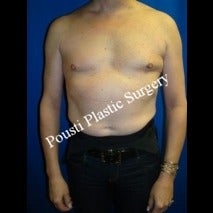 55-64 year old woman treated for Breast Implants before 1526882