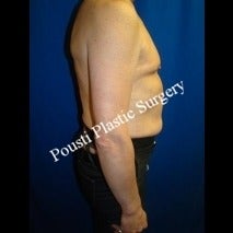 55-64 year old woman treated for Breast Implants 1526882