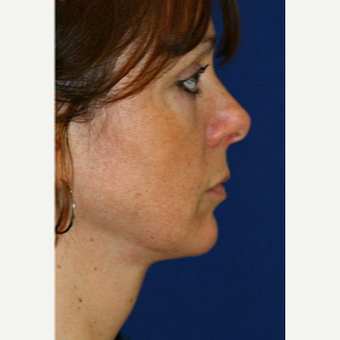 25-34 year old woman treated with Liposuction after 3646571