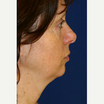 25-34 year old woman treated with Liposuction before 3646571