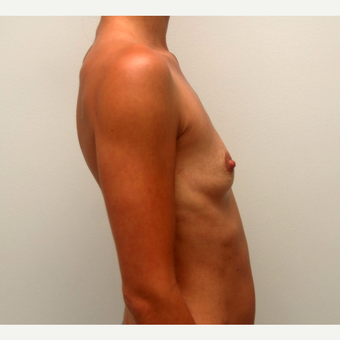 25-34 year old woman treated with Breast Augmentation before 3378606