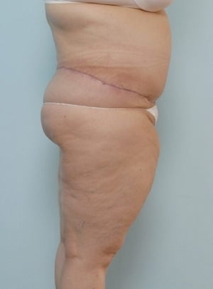 Body Lift after 1037866