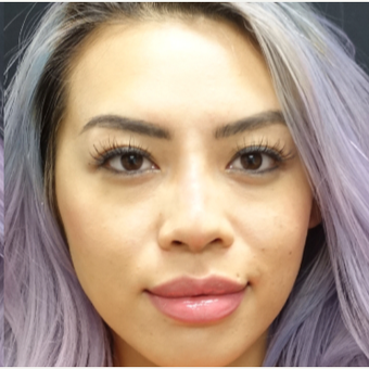 25-34 year old woman treated with Restylane for her Rhinoplasty after 3152195